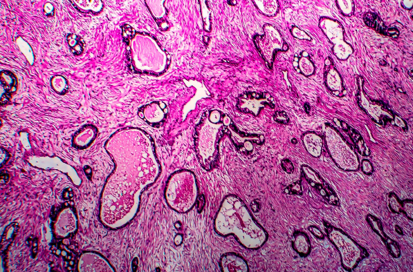 最新研究: 常用直发膏有患子宫癌的风险